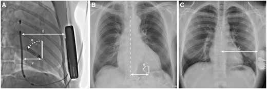 (A) AP fluoroscopy image of canine subject after LP and S-ICD implant. (B) PA X-ray of human subject post-implant. (C) PA X-ray of human subject after S-ICD implant. α, angle of LP orientation; ß, distance between S-ICD coil and shock generator; γ, distance of the LP to the S-ICD coil in canine subjects, or sternum in LP patients. AP, anterior–posterior; LP, leadless pacemaker; PA, posterior–anterior; S-ICD, subcutaneous implantable cardioverter-defibrillator.
