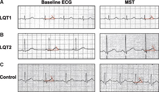 Example of electrocardiogram (ECG) at baseline and during mental stress test (MST) in type 1 LQTS patient (A), type 2 LQTS patients (B), and controls (C). ECG was performed at 25 mm/s and 10 mm/mV. QT interval measurement is defined as the intersection of the tangent of the T-wave and the isoelectric line (red line).