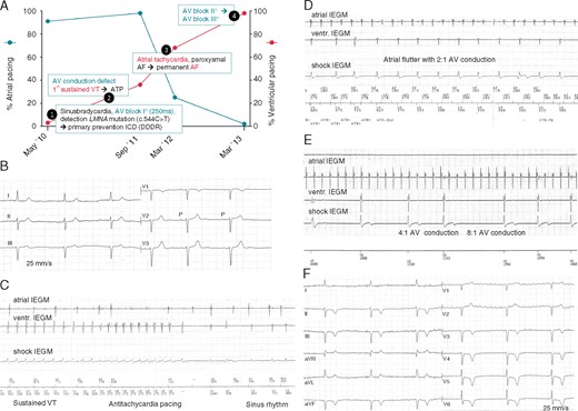 Clinical presentation of index patient. (A) Sequence of atrial and ventricular arrhythmia development in the index patient as exemplary time course in this LMNA family. Pacemaker pacing rates in the atrium (%, blue line, y-axis on the left) and in the ventricle (red line, y-axis on the right) are given over 3 years. Initially, sinus bradycardia with mainly atrial stimulation (91%) is observed, but no need for ventricular pacing (3%). Over time, AF burden increases and AV conduction worsens, leading to a decrease in atrial pacing (25%) and an increase in ventricular pacing (68%). Only 3 years after initial presentation, the patient is in permanent AF and complete AV-block (atrial pacing: 0%, ventricular pacing: 98%). (B) Initial ECG in 2010 showed sinus bradycardia (45 b.p.m.) and AV-block I° (PQ 250 ms) (indicated in time course as (1)). (C) IEGM obtained from ICD memory. A sustained VT (185 b.p.m.) is terminated by ATP 6 months after ICD implantation (indicated in time course as (2)). (D) Atrial flutter (atrial rate approx. 215–220 b.p.m.) with 2:1 AV conduction (indicated in time course as (3)). (E) Atrial flutter with 4:1 and 8:1 AV conduction. (F) Spontaneous ECG with pacemaker inhibition during regular pacemaker-check 5 years after initial diagnosis. The patient is in permanent AF and complete AV-block with junctional AV-escape rhythm (36 b.p.m.) (indicated in time course as (4)). Negative precordial T-waves are caused by permanent ventricular pacing (cardiac memory). AF, atrial fibrillation; ATP, antitachycardia pacing; AV, atrioventricular; DDDR, dual-chamber rate adaptive pacemaker; ECG, electrocardiogram; ICD, implantable cardioverter-defibrillator; IEGM, intra-cardiac electrocardiogram; VT, ventricular tachycardia.