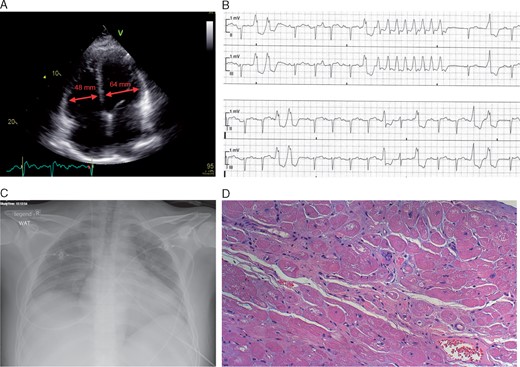 Clinical features in subtype with early severe heart failure. (A) Transthoracic echocardiogram with dilated cardiac cavities of patient V:16. left ventricular end diastolic diameter = 64 mm, right ventricular end diastolic diameter = 48 mm. (B) Non-sustained ventricular tachycardia on electrocardiogram telemetry. (C) Globally enlarged heart in chest radiography. (D) Histology of the explanted heart showed increased extracellular matrix, increased cardiomyocyte cell-size heterogeneity, cytoplasmic vacuoles, and absence of an inflammatory infiltrate. Hematoxylin and eosin stain.