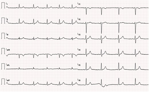 Non-diagnostic ECG at first presentation.