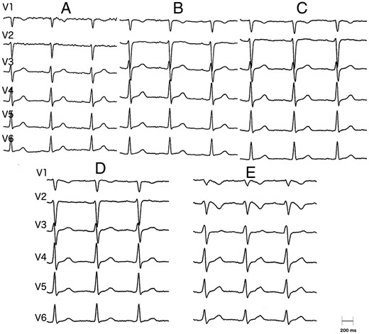 (A) ECG at 1 min, after the first bolus of ajmaline. (B) ECG at 2 min, after the second bolus of ajmaline. (C) ECG at 3 min, after the third bolus of ajmaline. (D) ECG at 4 min, after the fourth bolus of ajmaline, showing a slight, though not significative, prolongation of the QRS. (E) ECG at 5 min, after the last infusion of ajmaline, showing significative QRS prolongation and emergence of Brugada type 1 pattern.