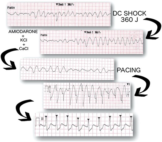 ECG evolution during advanced cardiopulmonary life support after the placement of ECMO. The rhythm evolved from a fine wave fibrillation to a coarse wave fibrillation after 2 DC 360 J shocks. After infusion of amiodarone, potassium chloride and calcium chloride, it became more organized allowing an external pacing to be effective. At last, a spontaneous rhythm occurred.