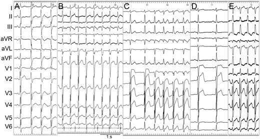 Representative ECG during sinus rhythm and VT. (A) ECG of Case 3. The first QRS was sinus rhythm. (B) ECG of Case 4. The third QRS was captured by sinus rhythm. The lowest tracing was intracardiac recording of CS catheter, which revealed the VA relationship. (C) ECG of Case 10. The first QRS was sinus rhythm. (D and E) Sinus ECG (Panel D) and VT ECG (Panel E) of Case 11.
