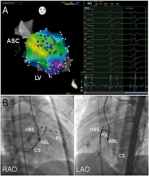 Typical target of LUS-VT. (A) Isochronal map of presystolic PP during VT. Yellow tags stand for His bundle and left bundle brand, pink tags left posterior fascicles and blue tags left anterior fascicles. Early presystolic PP electrograms are depicted in red, late in purple and electrograms in between by shades of color as shown in the reference color bar. White tags are anatomical tags which stand for sites without presystolic PP. The site with the earliest PP recorded was the successful ablation target (red tag) and the local electrogram is shown in the right window. MAP 1-2 and 3-4 stands for the distal and proximal electrodes of ablation catheter. ASC, aortic sinus cusp; LV, left ventricle; RAO, right anterior oblique. (B) Fluoroscopy of left upper septal target. ABL, ablation catheter; CS, coronary sinus catheter; HBE, His bundle electrogram recording catheter; LAO, left anterior oblique projection; RAO, right anterior oblique projection; and RV, right ventricle catheter.