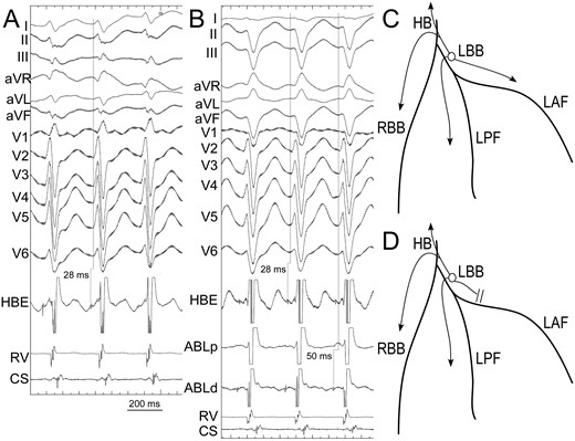 VT ECG change during mapping. In the beginning of the procedure, the VT showed precordial RBBB type and right axis deviation of frontal axis (Panel A). The H-V interval during VT was 28 ms. Due to simultaneous conduction through fascicles (Panel C), the VT QRS width was narrow. After inadvertent block of anterior fascicle during mapping (Panel D), the VT QRS showed left deviation of frontal axis and a precordial morphology similar to sinus QRS but with a deeper S wave in lead V6 (Panel B). The H-V interval was still 28 ms since the retrograde conduction of the earliest PP to His remained unchanged. CS, coronary sinus electrogram; HBE, His bundle electrogram; RV, right ventricle electrogram; ABL, ablation catheter; LAF, left anterior fascicle; LPF, left posterior fascicle; LBB, left bundle branch; HB, His bundle; Right bundle branch.