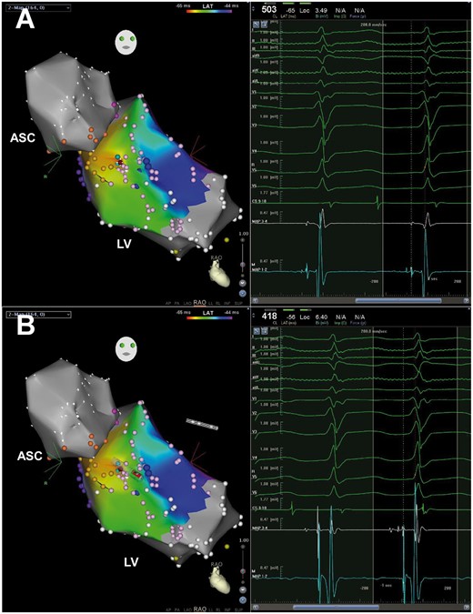 DP in Case 4. Yellow tags stand for His bundle and left bundle brand, pink tags posterior and anterior fascicles. The site with both DP and the earliest PP recorded was the successful ablation target (red tag) and the local electrogram is shown in the right window of Panel A. When advancing the ablation catheter, only the proximal electrodes can record the DP (Panel B). Abbreviations as Figure 2.