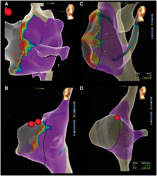 (A) Type I low-voltage bridges at voltage gradient mapping of Koch’s triangle. (B) Type II low-voltage bridges at voltage gradient mapping of Koch’s triangle. (C) A ‘double bridge’ case, with a low-voltage bridge extension in a mid-septal location and another appendage in the lower part of Koch’s triangle, at the coronary sinus ostium level. (D) Voltage gradient map of Koch’s triangle in a control patient.