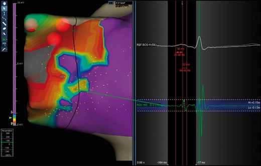 Typical ‘hump-and-spike’ electrogram (length and amplitude) recorded inside a type I bridge.
