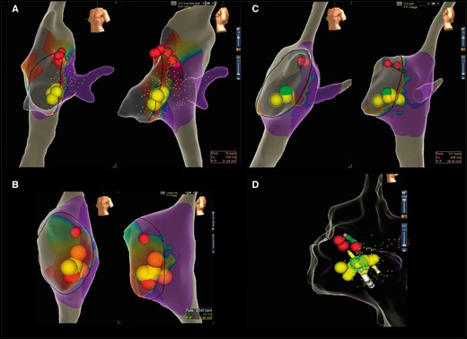 The different types of cryolesions performed depending on the size of bridges: (A) focal lesion; (B) extended focal lesion; (C) HDLL; (D) extended HDLL.
