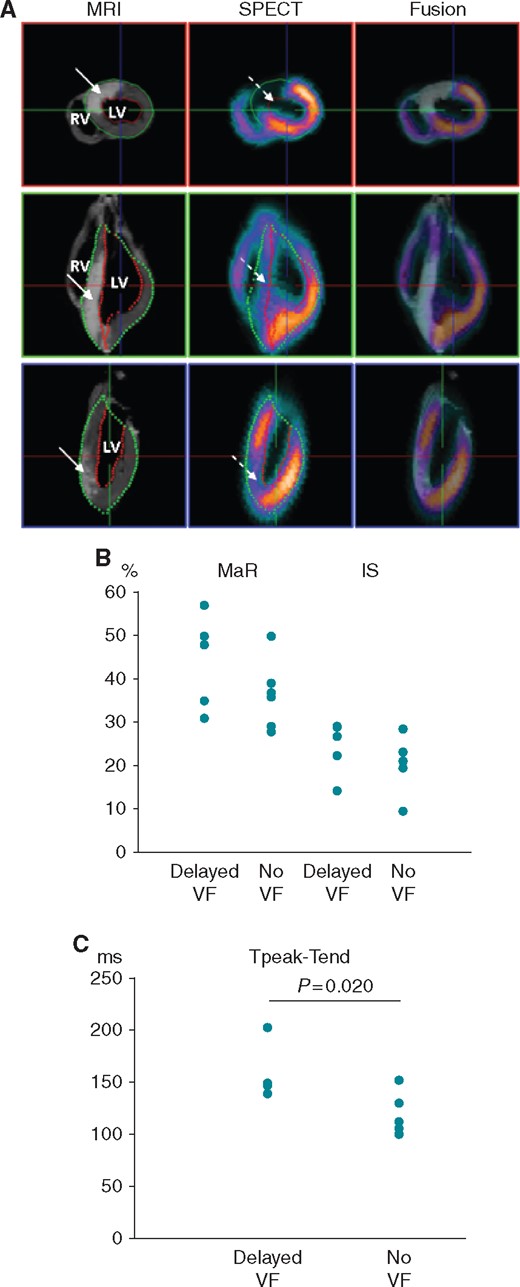 Individual values of the indices of ischaemic damage and ECG repolarization parameters in animals from the groups of delayed VF and no VF. (A) Representative images of MaR and IS in the pig heart after LAD occlusion. Left column: CMR performed for visualization of anteroseptal infarction (solid arrows, white colour). Middle column: SPECT visualization of the anteroseptal perfusion defect (dashed arrows, cold/absent colours). Right column: Fusion of MRI and SPECT images. The upper panel shows a mid-ventricular short-axis slice, and the lower two panels show two long-axis slices. From Demidova et al.15 with permission. (B) Individual values of the area at risk (MaR) and infarct size (IS) in delayed VF and no VF groups. (C) Individual values of Tpeak-Tend intervals measured at 10th minute of occlusion subsequently used for prediction of delayed VF.