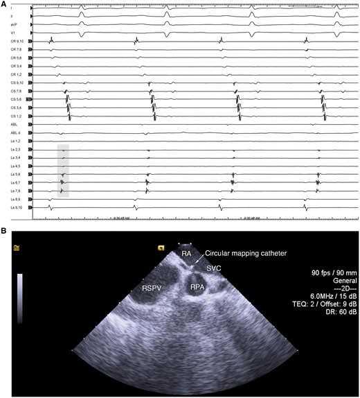 CMC at theSVC–RA junction. A: intracardiac electrograms showing sharp vein potentials (grey shade) and far-field RA electrograms. B: intracardiac echocardiography showing the CMC positioned between the RSPV and RPA. CMC, circular mapping catheter; RA, right atrium; RPA, right pulmonary artery; RSPV, right superior pulmonary vein; SVC, superior vena cava.