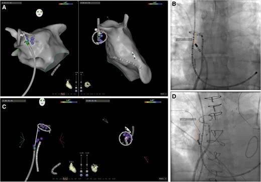 Example of measurements of the distance between the site of SVC isolation and the SVC–RA junction, which was approximated to the location of the CMC. The EAMs display a RAO, (left) and a LAO superior (right) view, whereas fluoroscopy shows an AP view. AP, anteroposterior; CMC, circular mapping catheter; EAM, electroanatomic map; LAO, left anterior oblieque; RA, right atrium; RAO, right anterior oblique; SVC, superior vena cava.