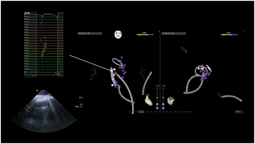 Phrenic nerve mapping (white dots) showing capture in the RA posterior wall, in a site of early activation (pink dot, MAP 1–2) relative to the earliest activation recorded on the CMC; in this patient, SVC isolation was not completed. CMC, circular mapping catheter; CR, crista terminalis; CS, coronary sinus; LS, circular mapping catheter; MAP, ablation catheter; RA, right atrium; SVC, superior vena cava.