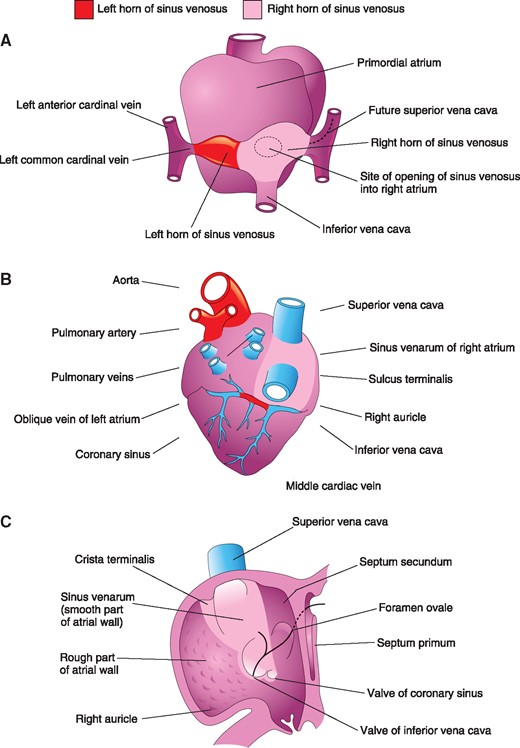 Illustrations of the primordial (A) and developed (B, C) right atrium and sinus venosus, showing SVC embryogenesis. With permission from Moore et al.11