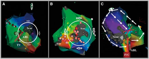 Electroanatomical activation mapping and ablation using RMN of incisional atrial tachycardia post-surgery. (A) Activation map illustrating the circuit is a clockwise loop around RA septal atriotomy scar only. The slow conduction zone of this circuit (marked as two parallel red lines) is located between the scar and tricuspid annulus. (B) Activation map illustrating the circuit is a clockwise loop around RA free wall atriotomy scar only. The slow conduction zone of this circuit (marked as two parallel red lines) is located between the scars. Some abnormal potential around and inside of the larger scar was also ablated. (C) Activation map illustrating the circuit is a counterclockwise loop around RA septal atriotomy scar and tricuspid annulus. The region between the scar and tricuspid annulus appears to be a slow conduction zone; however, there is a complete block line which marked as green dots. The slow conduction zone of this circuit (marked as two parallel red lines) is located between the scar and inferior vena cava and the tip of ablation catheter connect this zone. ABL, ablation catheter; IVC, inferior vena cava; RA, right atrium; RMN, remote magnetic navigation; TV, tricuspid annulus.