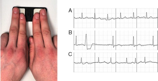 Index and middle fingers on a mobile iECG (left panel); excerpts from resulting iECGs (right panel): (A) SR, (B) SR with ectopic beats, and (C) AF (right panel). AF, atrial fibrillation; iECG, internet-enabled electrocardiography; SR, sinus rhythm.