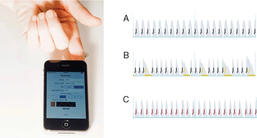 PPG recording with a smartphone camera on the index finger (left panel); excerpts from resulting pulse waves (right panel): grey wave form indicates the pulse wave, black projected spikes indicate a regular heartbeat (A). Yellow spikes indicate an irregular heartbeat (e.g. ectopic beat) (B), red spikes an extremely irregular heart rhythm (absolut arrhythmia) (C). PPG, photoplethysmography.