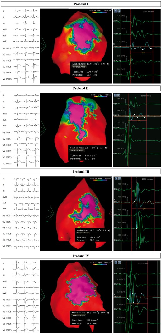 Arrhythmogenic substrate characterization in Probands I–IV. Electrocardiogram (left) demonstrates the type 1 BrS pattern after ajmaline administration, confirming the diagnosis. Potential duration map after ajmaline infusion (centre) reveals the full extent of the arrhythmogenic substrate. BrS, Brugada syndrome.