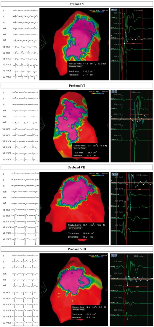 Arrhythmogenic substrate characterization in Probands V–VIII. Electrocardiogram (left) demonstrates the type 1 BrS pattern after ajmaline administration, confirming the diagnosis. Potential duration map after ajmaline infusion (centre) reveals the full extent of the arrhythmogenic substrate. BrS, Brugada syndrome.