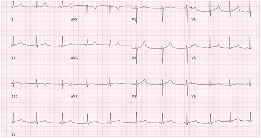 A 12-lead ECG of patient with R860Q variant. Note prolonged QTc with late peaking T wave and steep descending limb. 25 mm/s, 10 mm/mV. ECG, electrocardiogram.