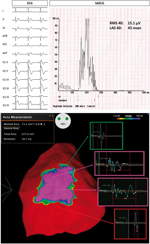 Example of Group 1 patient, with spontaneous Type 1 ECG BrS pattern (top panel on the left), who survived a previous CA. SAECG showed abnormal LPs (top panel on the right). Baseline epicardial mapping demonstrated a large area (15.1 cm2) of abnormal potentials (bottom panel). BrS, Brugada syndrome; CA, cardiac arrest; ECG, electrocardiogram; LAS, low-amplitude signal; LPs, late potentials; RMS, root mean square; SAECG, signal-averaged electrocardiogram.