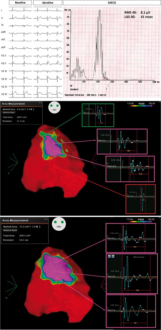 Group 1 patient, with ajmaline-induced Type 1 pattern (top panel), who experienced previous spontaneous VT/VF episodes. SAECG showed abnormal LPs (top panel). Baseline epicardial mapping demonstrated a large area (6.9 cm2) of abnormal potentials (middle panel). After ajmaline administration, with the occurrence of Type 1 ECG, the substrate area increased at 15.4 cm2 (bottom panel). LAS, low-amplitude signal; LPs, late potentials; RMS, root mean square; SAECG, signal-averaged electrocardiogram; VT/VF, ventricular tachycardia/ventricular fibrillation.