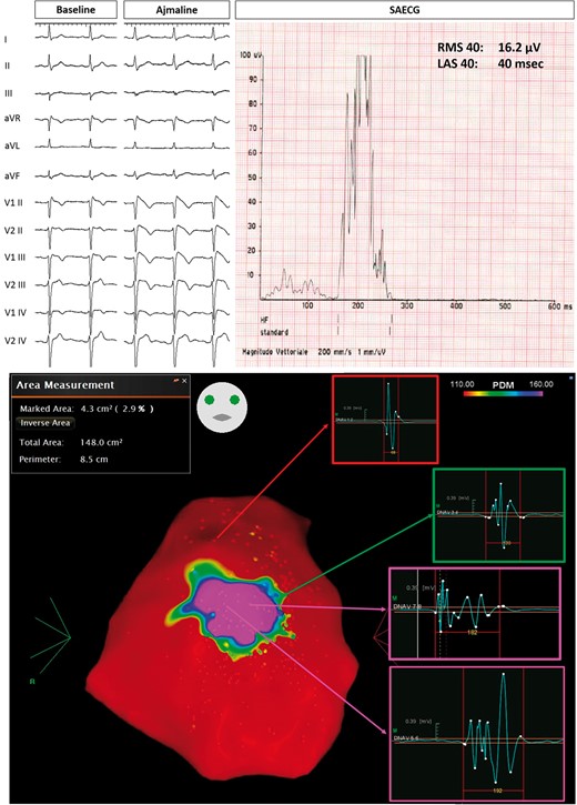 Example of Group 2 patient, with drug-induced Type 1 pattern (top panel on the left). SAECG showed abnormal LPs (top panel on the right). Baseline epicardial mapping demonstrated a 4.3 cm2 area of abnormal electrograms (bottom panel). LAS, low-amplitude signal; LPs, late potentials; RMS, root mean square; SAECG, signal-averaged electrocardiogram.