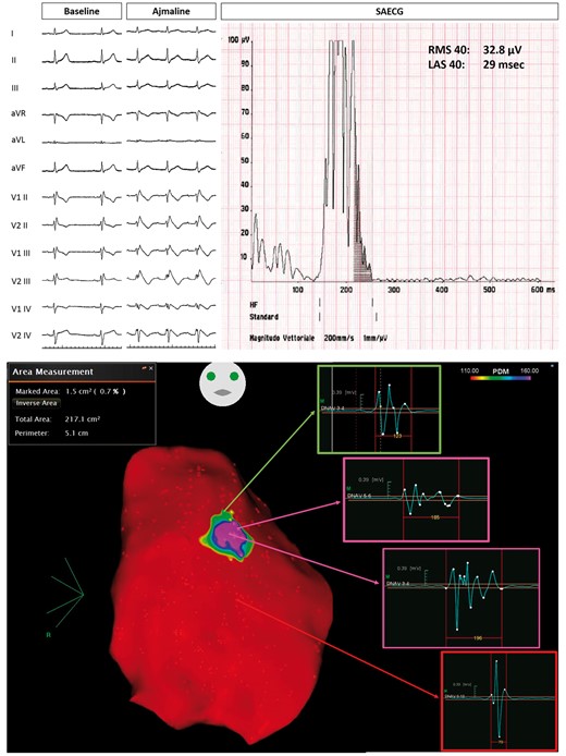 Example of Group 2 patient, with ajmaline-induced Type 1 pattern (top panel). Baseline epicardial mapping demonstrated a small area (1.5 cm2) of delayed electrograms (bottom panel). LAS, low-amplitude signal; RMS, root mean square; SAECG, signal-averaged electrocardiogram.