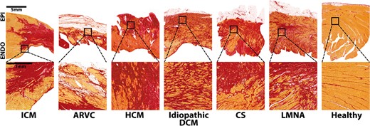 Examples of scar pattern in different aetiologies of structural heart disease. Stained with sirius red (fibrosis stains red, viable myocardium yellow). Ischaemic cardiomyopathy (ICM): compact scar extending from the subendocardium to the epicardium with sparing of the endocardial rim. Along the border, viable myocardium is interspersed by fibrous tissue.4–10 Arrhythmogenic right ventricular cardiomyopathy (ARVC): genetic disease,11,12 characterized by fibrofatty replacement of myocytes starting at the subepicardium,13–16 most frequently affecting the right ventricle with biventricular disease in approximately half of the cases, whilst the septum is rarely involved.13,17 Hypertrophic cardiomyopathy (HCM): autosomal dominant inherited disease,18,19 characterized by myocyte hypertrophy and disarray, starting at the subendocardium19–21 with interstitial collagen expansion, leading to interstitial fibrosis, preferentially involving the septum, followed by the lateral and apical left ventricular wall.19,21 Small vessel involvement may cause myocardial ischaemia and replacement fibrosis.19 Idiopathic dilated cardiomyopathy (DCM): highly variable scar pattern, including subendocardial, subepicardial, mid-wall, and transmural patterns; patchy or diffuse architectures are most frequently seen.22–28 Here, an example of diffuse fibrosis extending transmurally is given. Cardiac sarcoidosis: demarcated areas of irregular non-necrotising granulomas leading to patchy fibrosis,29–32 mainly affecting the left ventricle and the septum, followed by the right ventricle.29–31 LMNA-mutation: one example of a patient with dominant, but not exclusively, mid-myocardial (predominantly interstitial) fibrosis, primarily involving the basal septum, the conduction system, and the posterior left ventricular wall.33–36 Healthy control: minimal interstitial fibrosis between bundles of myocardium. Post-myocarditis (not shown): heterogeneous disease,37 histologically defined by an inflammatory infiltrate with necrosis, leading to fibrosis.38