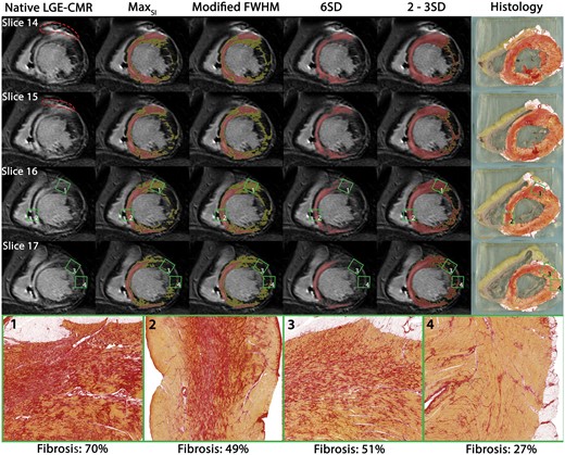 Reprinted with permission from EHJ.22 Different scar delineation techniques applied in dilated cardiomyopathy: different LGE-CMR scar delineation methods applied to one patient with DCM with corresponding histology. Red dotted line: ICD artefact. Red: scar core. Yellow: scar border zone according to different methods. Green squares: locations of high-resolution histology inserts from non-ablation locations. Areas of dense mid-septal fibrosis surrounded by viable myocardium corresponded well with areas of LGE on CMR (insert 2). Despite high quantity, less well delineated fibrosis (insert 1) was only identified as core scar when using the 2–3SD method; as border zone when using the SImax or modified full width at half maximum method. Despite comprising more than 50% fibrosis, a diffuse pattern was not detected on LGE-CMR irrespective of method used (insert 3). CMR, cardiac magnetic resonance; FWHM, full width at half maximum; LGE, late gadolinium enhancement; SD, standard deviation.