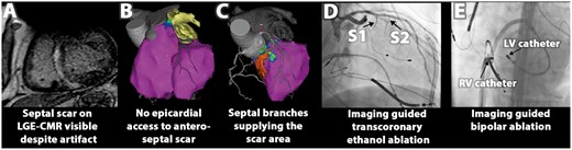 Example of multimodal image integration to facilitate bailout treatment strategies: (A) pre-procedural LGE-CMR shows septal scar, extending to left ventricular (LV) summit. (B) Integrated biventricular endocardial mapping (right ventricular (RV) and LV bipolar voltage maps, purple indicates normal bipolar voltage) confirms that the scar is not accessible through epicardial approach. (C) LV unipolar voltage mapping (purple indicates normal voltages) could not delineate the entire segmented scar (shown in orange), which was supplied by two septal branches (S1 and S2) as evident from CT/CMR image integration, allowing for transcoronary ethanol ablation (D) and imaging guided bipolar ablation between two ablation catheters located at the RV and LV site of the segmented scar (E). Bailout strategies reduced VT burden in this patient; after surgical resection patient has been entirely VT free. CMR, cardiac magnetic resonance; LGE, late gadolinium enhancement.