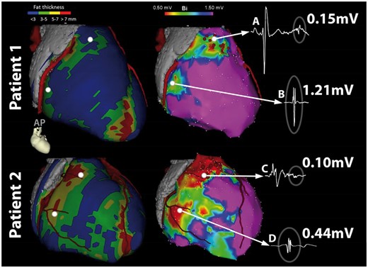 Modified from JACC, reprinted with permission.151 CT-Image integration used to visualize epicardial fat thickness for interpretation of epicardial BV: two endurance athletes with isolated epicardial scar in the anterior right ventricular outflow tract. Left: epicardial contours colour-coded for epicardial fat thickness according to bar, together with coronary arteries in a modified right anterior oblique view, right: epicardial bipolar voltage maps from the same two patients. Integration of epicardial fat images together with abnormal electrogram characteristics allows for classification of electograms; (A) low-voltage electrogram with late potential in area without fat is due to scar (B) low voltage due to fat (C) low voltage, fragmented electrogram due to scar potentially attenuated due to fat (D) very low-voltage electrogram due to fat.