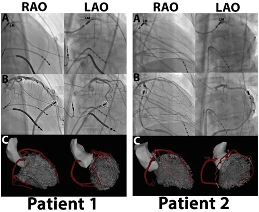 Evaluation of the image integration accuracy using the left main as single landmark: (A) left main (LM) position confirmed by contrast injection through irrigation port of ablation catheter. LM position tagged and used to align images. (B, C) Unique anatomical features used to confirm accuracy of integration. Catheter located epicardially next to curvature (Patient 1) or bifurcation (Patient 2), as seen on coronary angiography. Location of catheter as visualized on CARTO-software confirms location at same anatomical location relative to coronary anatomy without additional automatic or manual adaption after single-landmark image integration. LAO, left anterior oblique; RAO, right anterior oblique.
