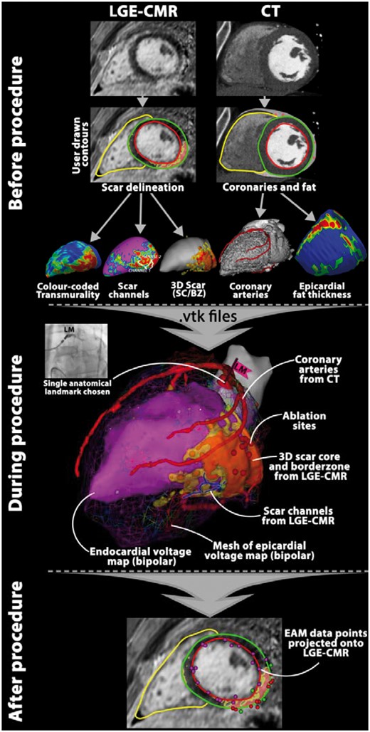 Example of workflow for image integration using CARTO® 3: see text for additional explanation. BZ, border zone; CMR, cardiac magnetic resonance; CT, computed tomography; EAM, electroanatomical mapping; LGE, late gadolinium enhancement; SC, scar core.