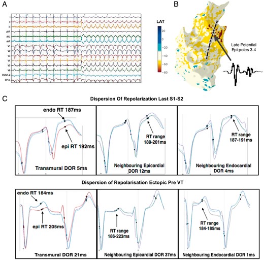 DOR and initiation of VT in an example patient (Patient 6). (A) S1–S2 restitution protocol, showing 12-lead ECG and sample unipolar electrograms from the RV endocardium and RV epicardium. Following a train of S1 pacing, an S2 beat is delivered, following this an RV ectopic beat triggers sustained VT. (B) RV Endo geometry and activation mapping of the sustained VT showing earliest activation (red area), in the RVOT, along with location of transmurally opposed Endo and Epi decapolar catheters from the restitution study. Poles 3 and 4 of Epi catheter were located over a region of late potentials in sinus rhythm (inset). (C) DOR at Epi catheter pole location 3–4 (where fractionation was recorded), in the neighbouring Epi poles to 3–4, and in the neighbouring adjacent linear Endo poles. DOR is shown for the last S2 beat (above panel) and for the ectopic beat subsequent to this which initiates sustained VT. Circles represent activation time, triangles represent repolarization time. DOR, dispersion of repolarization; Endo, endocardial; Epi, epicardial; RV, right ventricular; RVOT, right ventricular outflow tract; VT, ventricular tachycardia.