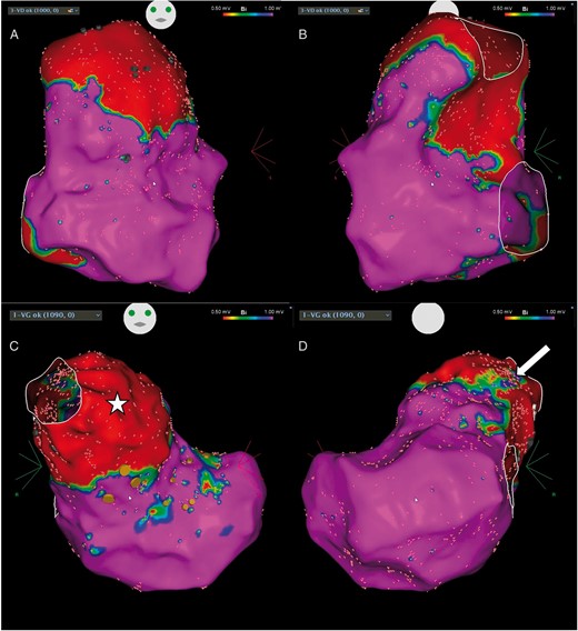 Right and left ventricular voltage maps performed during the redo procedure (A and B: RV in antero-posterior and postero-anterior views, respectively; C and D: LV in antero-posterior and postero-anterior views, respectively). The scar areas are similar to those found during the initial procedure in the RV. A large zone of scar was found in the LV outflow tract (C, star) except in its’ anterior segment (D, arrow). Orange dots denote the position of the His-bundle recording. LV, left ventricle; RV, right ventricle.
