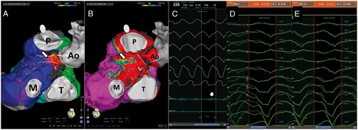 (A) Activation map of the VT induced (left postero-lateral view, Ao, aorta; M, mitral annulus; P, pulmonary annulus; T, tricuspid annulus). The position of the ablation lesions are indicated by the arrow. (B) The zone harbouring the diastolic potential, where ablation was performed was located in a small region of normal voltage along the anterior aspect of the LV outflow tract (arrow). (C) A mid-diastolic potential found in this given spot (blue line, arrow). The QRS pattern during entrainment in the middle and at the exit site of VT isthmus are shown in D and E. A 93.8% correlation was observed between the clinical VT and the pacing, with a long S-QRS in the middle of the isthmus and a short one at the exit site. LV, left ventricle; VT, ventricular tachycardia.