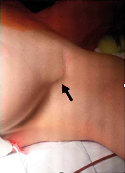 Generator migration (arrow) into the apex of the axilla that resulted in movement-triggered pain in one study patient.