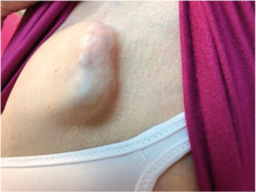 Example of poor surgical technique that resulted in subcutaneous generator placement.