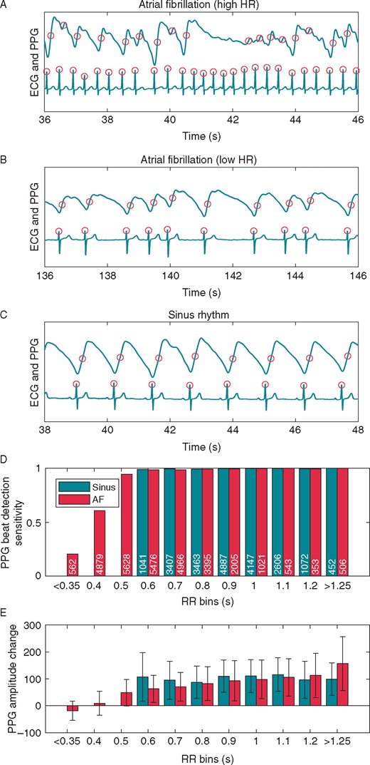 Example ECG and PPG data samples from three different subjects and analysis of all the individual pulses divided into bins. Detected individual pulses are marked with circles in AF samples (A, B) and in SR sample (C). In the case of rapid AF (sample A), some pulses with a low RR interval are not detected from the PPG signal due to the low PPG amplitude. Analysis of all of the individual pulses detected from the ECG data divided into bins according to RR intervals and rhythm type are shown in D and E: SR or AF. For example, the RR bin 0.6 includes all RR intervals between 0.551 and 0.650 s. (D) The bar height represents the sensitivity of pulse detection from PPG for all the pulses within each bin. The value denotes the pulse count in the bar. Values for bins with less than 150 pulses are not shown. (E) The bar height represents the amplitude change (mean and SD) of the PPG signal from a 0.3 s window after each pulse detection from ECG. The negative AF PPG amplitude change with RR bins <0.35 s is due to the lowering of the PPG signal as seen in the AF sample in A. AF, atrial fibrillation; ECG, electrocardiogram; HR, heart rate; PPG, photoplethysmography; SR, sinus rhythm.