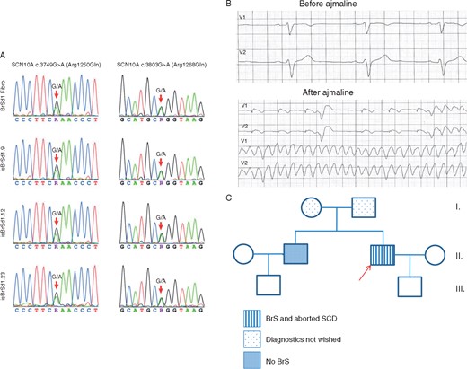 (A) Presence of the SCN10A variants c.3749G>A (p.Arg1250Gln) and c.3803G>A (p.Arg1268Gln) is confirmed by bidirectional Sanger sequencing in the patient’s fibroblasts and the three generated hiPSCs of the BrS patient. (B) The ECG of the BrS patient shows a normal ECG at baseline (before ajmaline), 50 mm/s. After a dose of 70 mg ajmaline, ventricular fibrillation was documented (before dose: upper panels, after dose: lower panels) and terminated with an ICD shock. (C) The pedigree of the family with BrS. The patient recruited for this study is marked by the arrow. Squares: men, circles: women. BrS, Brugada syndrome; ECG, electrocardiogram; hiPSC, human-induced pluripotent stem cell; ICD, implantable cardioverter-defibrillator; SCD, sudden cardiac death.