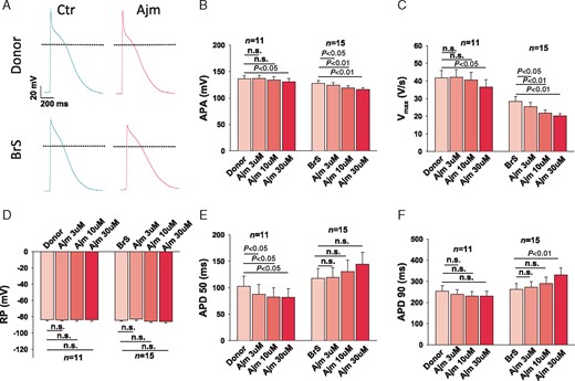 Enhanced effects of ajmaline on action potential in hiPSC-CMs from the BrS patient. The same cells were measured after sequentially adding the three concentrations of ajmaline (3 µM, 10 µM, and 30 µM) from low to high concentrations. (A) Representative traces of action potentials in donor (D1) and BrS cells. (B) Mean values of APA in absence (Donor/BrS) and presence of ajmaline in different concentrations. (C) Mean values of maximal depolarization velocity (Vmax) of action potentials in absence (Donor/BrS) and presence of ajmaline in different concentrations. (D) Mean values of RPs in absence (Donor/BrS) and presence of ajmaline in different concentrations. (E) Mean values of action potential duration at 50% repolarization (APD50) in absence (Donor/BrS) and presence of ajmaline in different concentrations. (F) Mean values of action potential duration at 90% repolarization (APD90) in absence (Donor/BrS) and presence of ajmaline in different concentrations. APA, action potential amplitude; BrS, Brugada syndrome; hiPSC-CMs, human-induced pluripotent stem cell-derived cardiomyocytes; n, number of cells; n.s., not statistically significant; RP, resting potential.