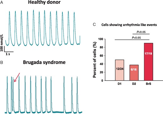 Increased arrhythmic events in BrS-hiPSC-CMs. Spontaneous Ca2+-transients were measured in donor- and BrS-hiPSC-CMs arrhythmic events (EAD- or DAD-like events) and the interval variation were evaluated. (A and B) Representative traces of Ca2+-transients in a donor and a BrS cell. (C) Numbers of cells showing arrhythmic events or enhanced interval variation (irregular transients). BrS, Brugada syndrome; hiPSC-CMs, human-induced pluripotent stem cell-derived cardiomyocytes.
