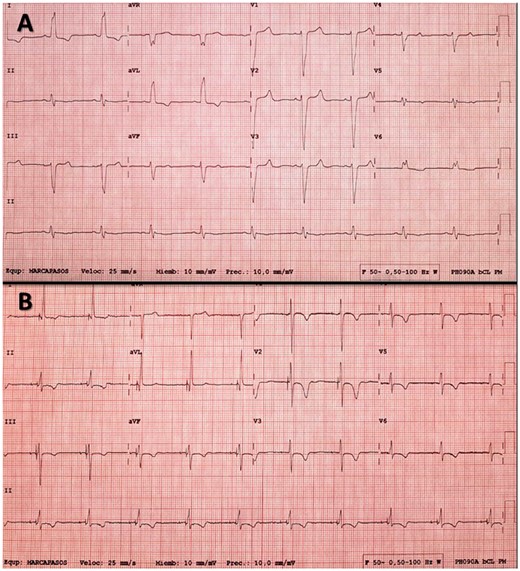 (A) Electrocardiogram of a patient with left bundle branch block (LBBB). (B) Electrocardiogram after permanent His bundle pacing resynchronization; note selective capture of the His bundle (latency between the spike and paced QRS) and disappearance of the LBBB.
