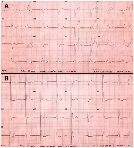 (A) Basal electrocardiogram of a patient with left bundle branch block (LBBB). (B) The same patient after permanent His bundle pacing. The correction of the LBBB was observed; in this case, both the His bundle and adjacent myocardium are captured (fusion), showing a pseudo delta wave at the beginning of the QRS.
