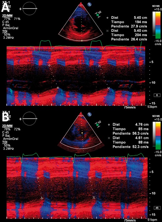 (A) Echocardiogram of a patient with left bundle branch block (M-mode colour tissue Doppler imaging) showing a septum-posterior wall (SPW) delay of 194–204 ms; note the wide QRS in the derivation of the echocardiogram. (B) Echocardiogram after permanent His bundle pacing resynchronization with an SPW delay of 85–88 ms; note the narrow QRS compared to that in (A).