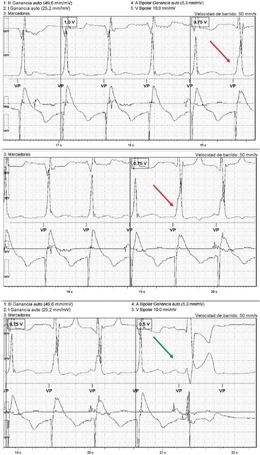 Register of the programmer with the intracardiac recording and the ECG monitor showing that there is a loss of His capture at 0.75 V with a change in the morphology of the QRS (red arrow), which increases in duration. At 0.5 V there is a loss of total capture (green arrow). In this case, the His threshold with LBBB correction is 1 V (0.4 ms) and the myocardium threshold is 0.75 V. ECG, electrocardiogram; LBBB, left bundle branch block.