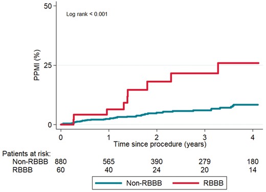 Kaplan-Meier curves of PPMI during follow-up, according to pre-existing RBBB. PPMI, permanent pacemaker implantation; RBBB, right bundle branch block.