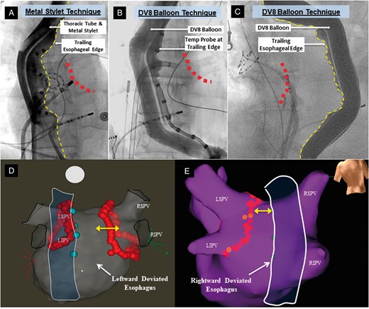 Mechanical oesophageal deviation techniques and electroanatomical mapping. These fluoroscopic anteroposterior views show MED using either rightward deviation with the malleable metal stylet (A) or balloon retractor (B) or leftward deviation with the balloon (C). Contrast is instilled into the oesophageal lumen to delineate the trailing edge (dotted yellow lines). The red dots represent the approximate location of the posterior ablation line. A temperature probe is also on the oesophageal trailing edge in (A) and (B); (C) is from a patient in whom a temperature probe was not used (and not included in this study dataset) in order to better delineate the edge of oesophagus clearly. Representative electroanatomical maps are shown in (D) and (E). The closest border of the deviated oesophagus (outline created artificially to display this) is marked with cyan tags on the electroanatomic map. These tags were placed on the map by visually aligning the ablation catheter on the posterior wall to the trailing oesophageal edge on an anteroposterior view. LIPV, left inferior pulmonary vein; LSPV, left superior pulmonary vein; MED, mechanical oesophageal deviation; RIPV, right inferior pulmonary vein; RSPV, right superior pulmonary vein.
